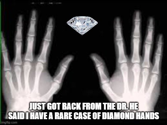 WŁAŚNIE WRÓCIŁEM OD LEKARZA. POWIEDZIAŁ, ŻE MAM RZADKĄ PRZYPADŁOŚĆ DIAMOND HANDS